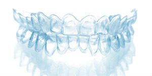 Image of Invisalign braces as an alternative to traditional braces.