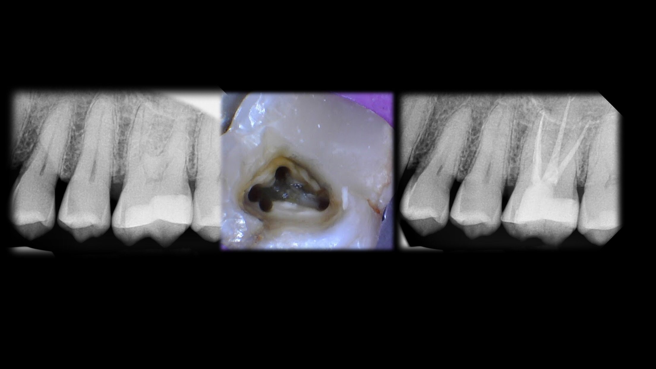Root Canal Treatement Case