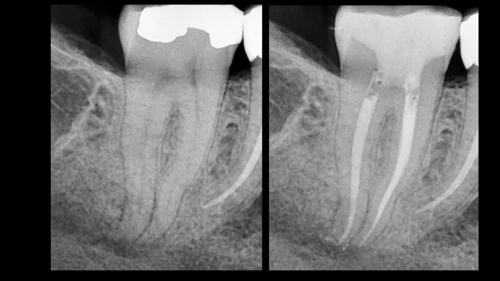 Root Canal Treatement Case