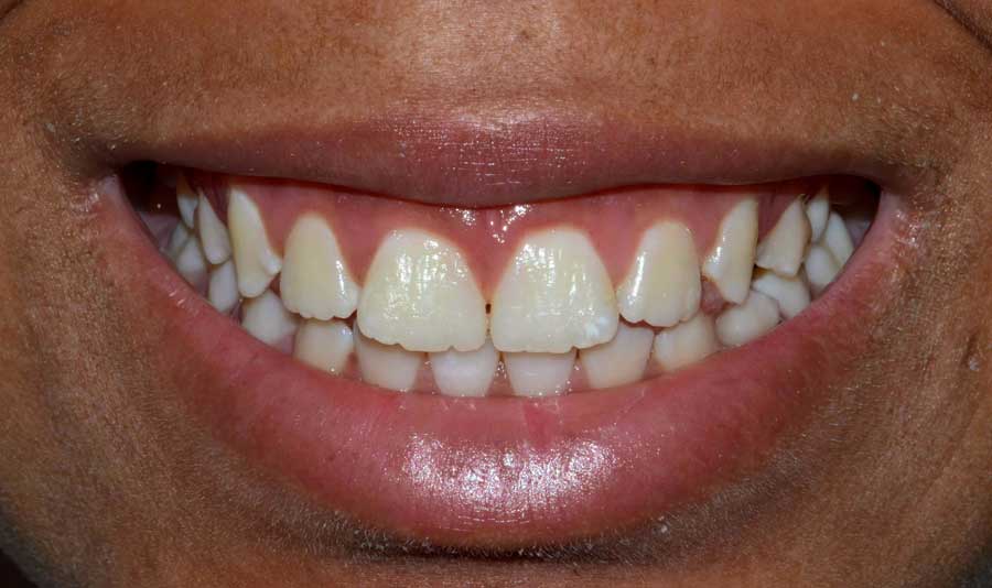 Gummy Smile Dental Case