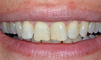 Worn Dentition Case