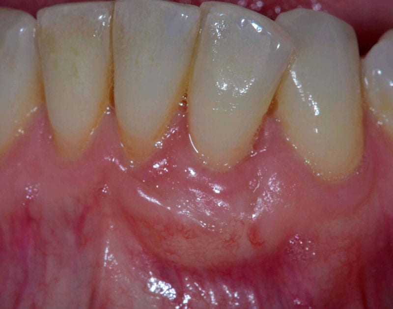 Root Coverage Dental Case