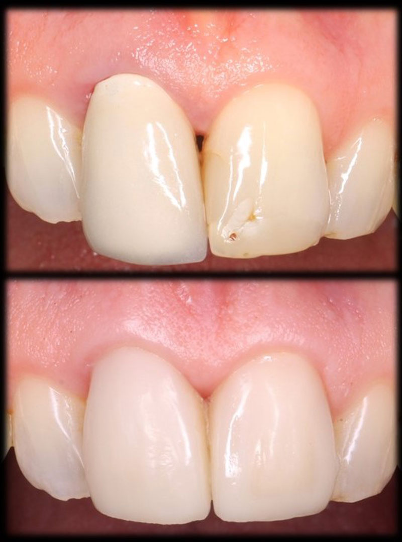 crown and bridge dental case