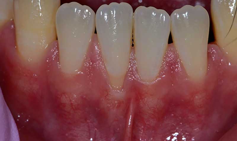 Root Coverage Dental Case