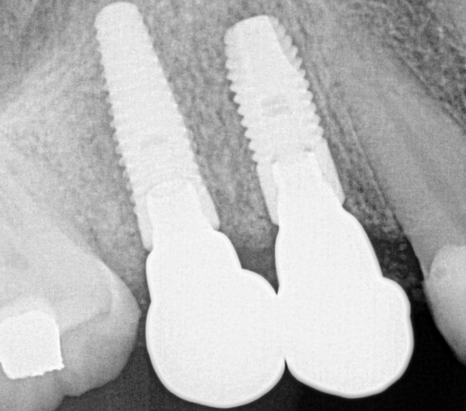 Dental Implant Case