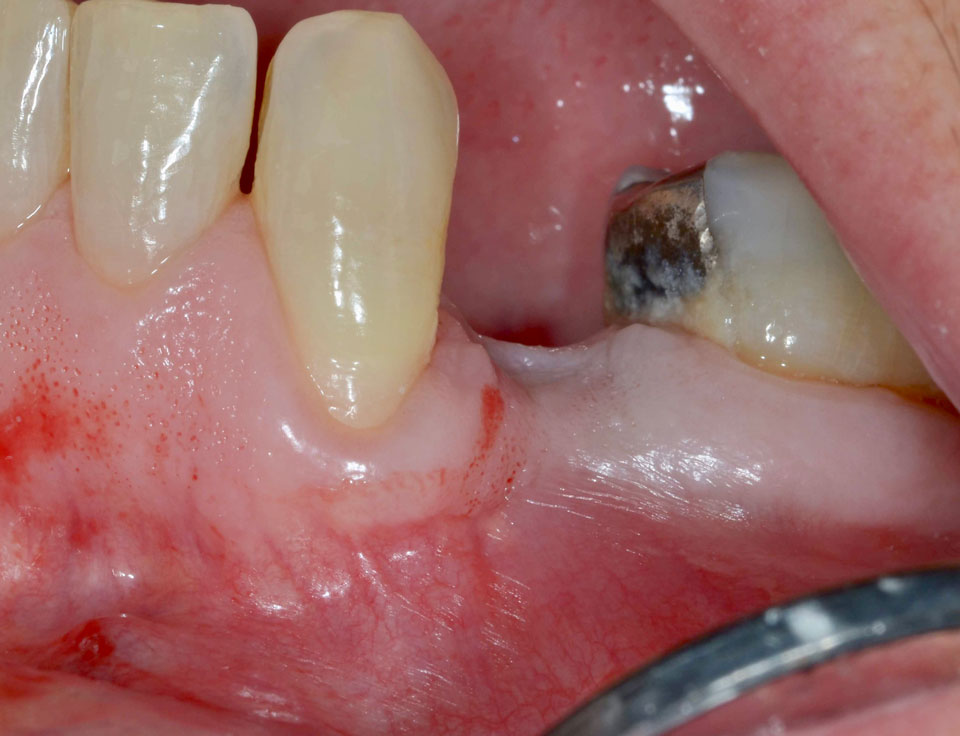 Dental Implant Case 47 - Before