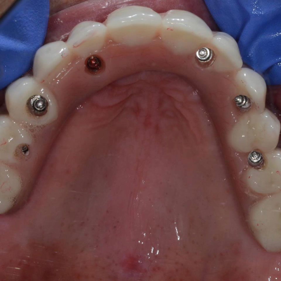 Dental Implant Case 50 - Top View