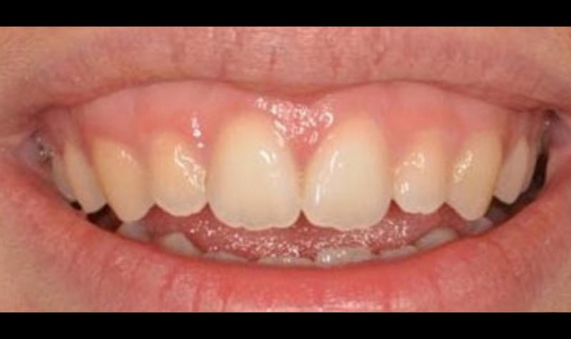 Dental Bonding Case - Before