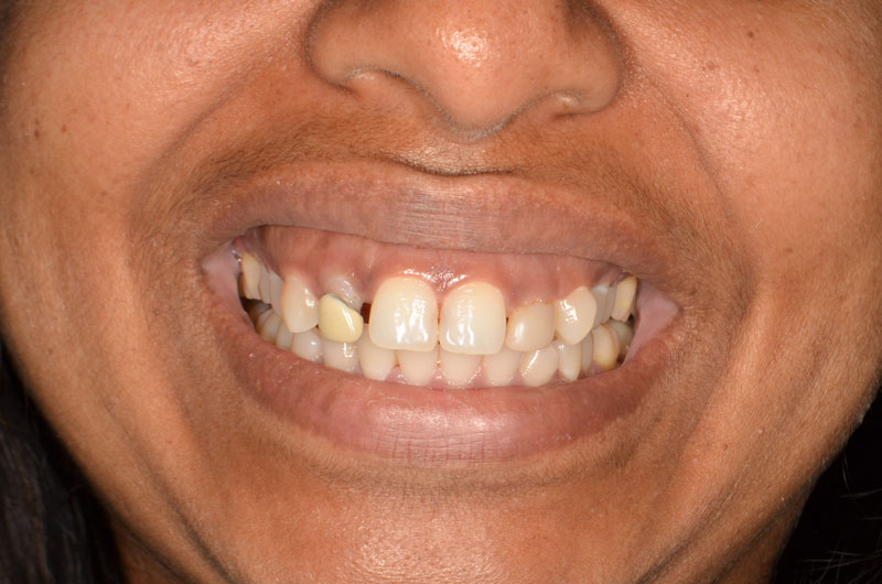 Dental Bonding Case