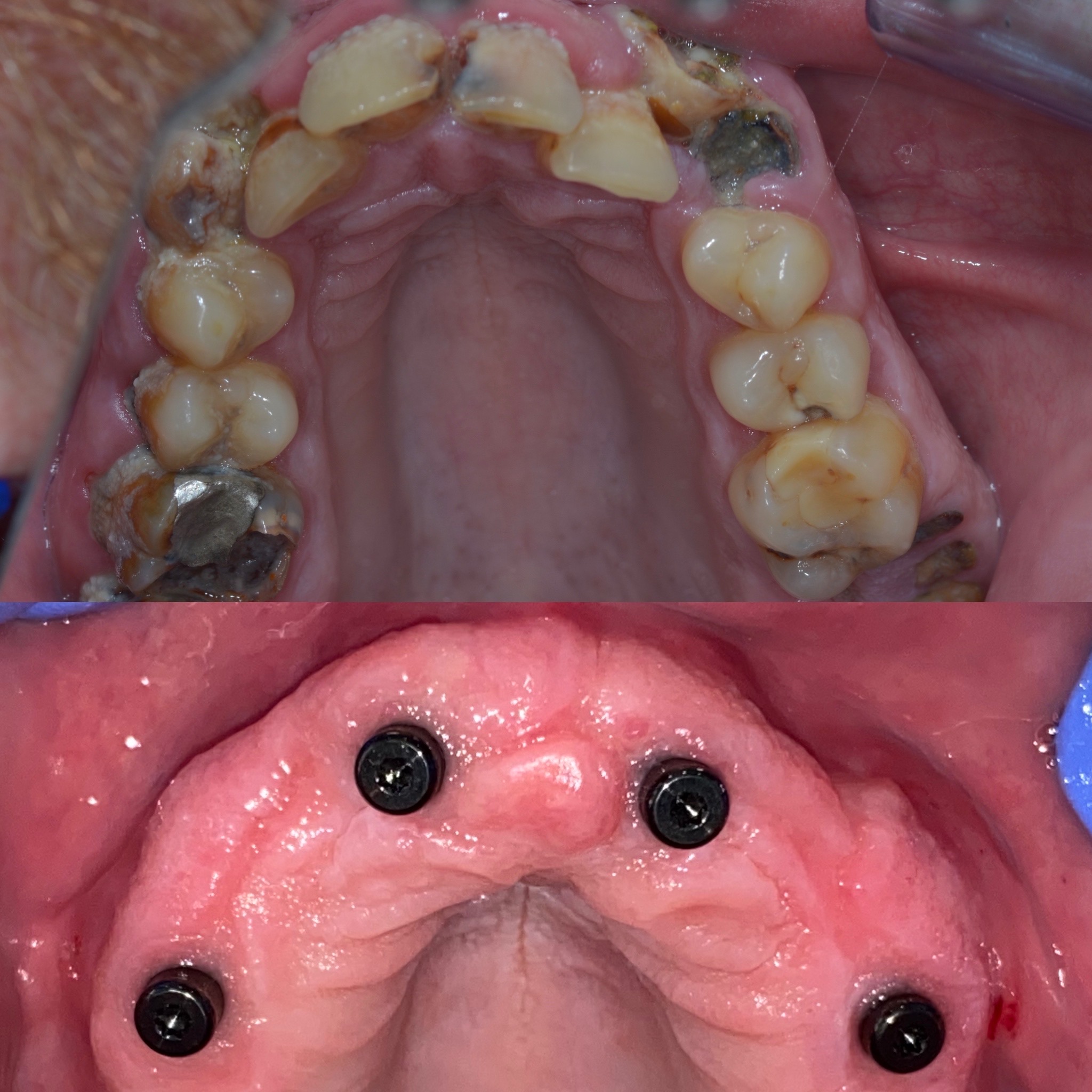 Dental Implant Case 53