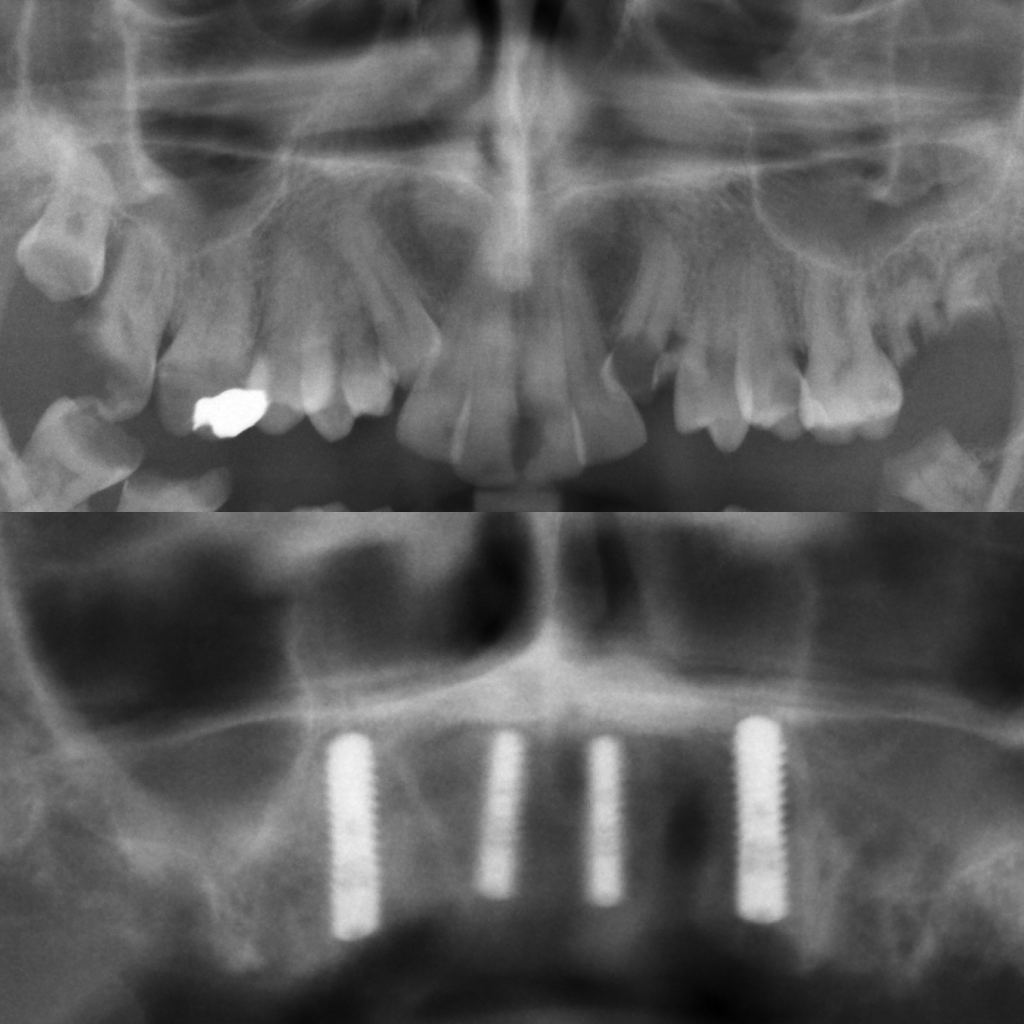 Dental Implant Case 53
