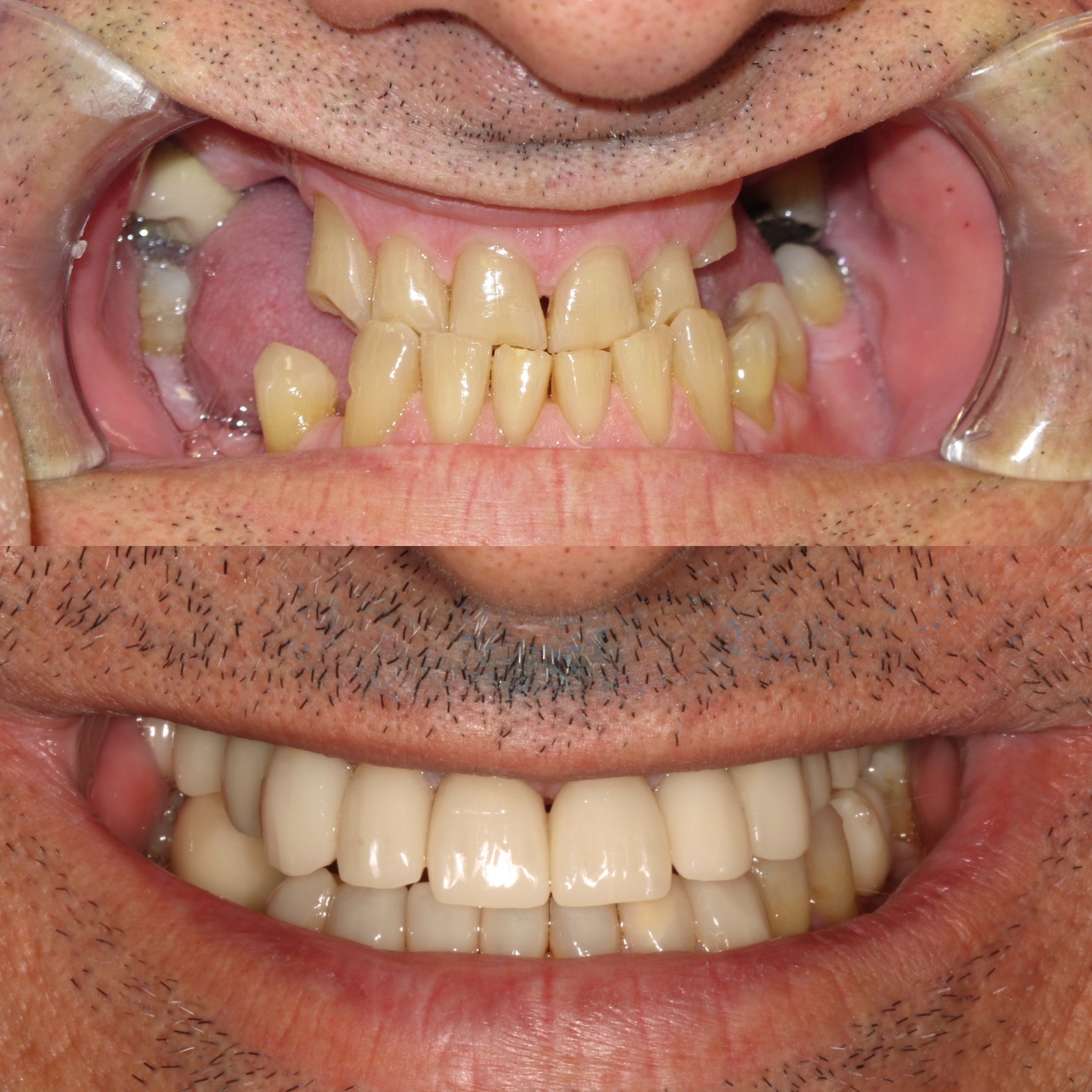 Dental Implant Case 54
